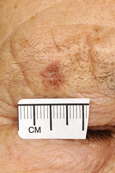 What does skin cancer look like: Actinic keratosis