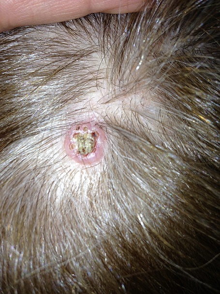 What does skin cancer look like? Keratoacanthoma