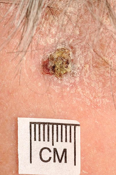 Squamous Cell Carcinoma- what does skin cancer look like?