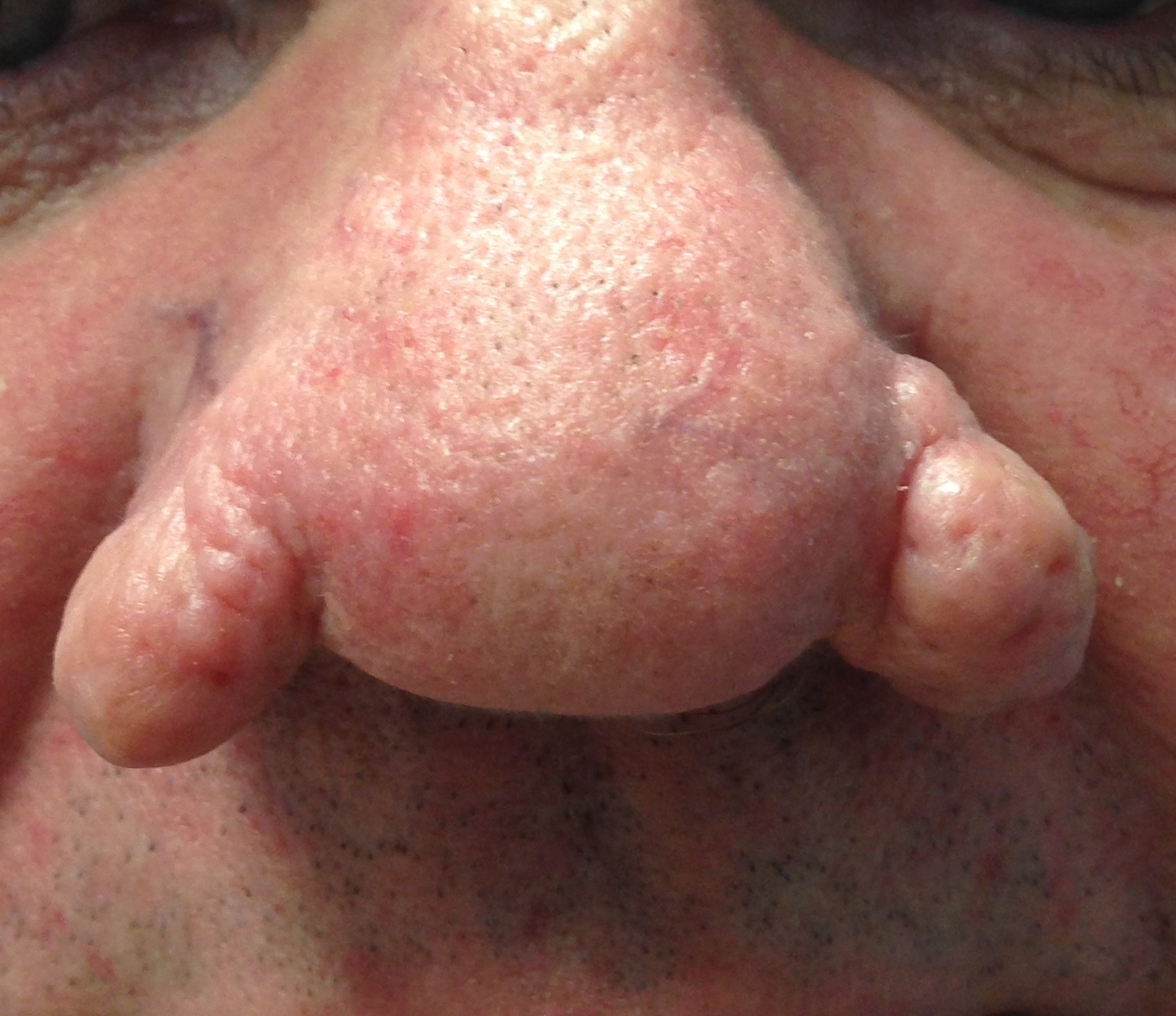 Rhinophyma- Seek Acne RosaceaTreatment from a Dermatologist