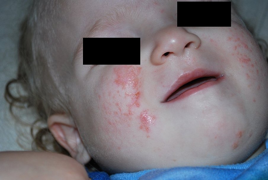 Baby rashes on the face