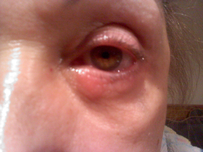 Contact Dermatitis treatment on the eyelids- involves avoiding the offending agent