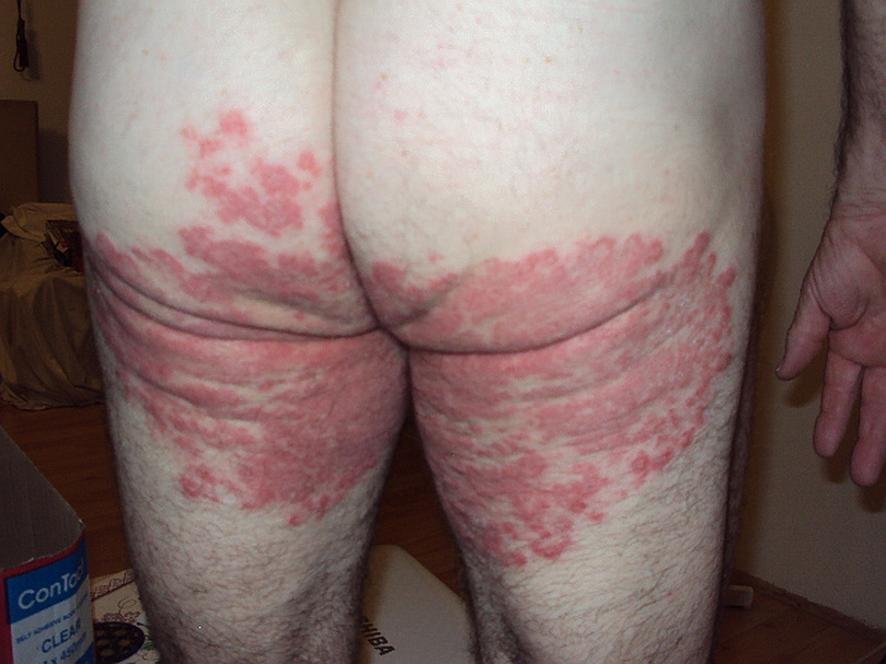 Contact Dermatitis Treatment- avoid the offending agent