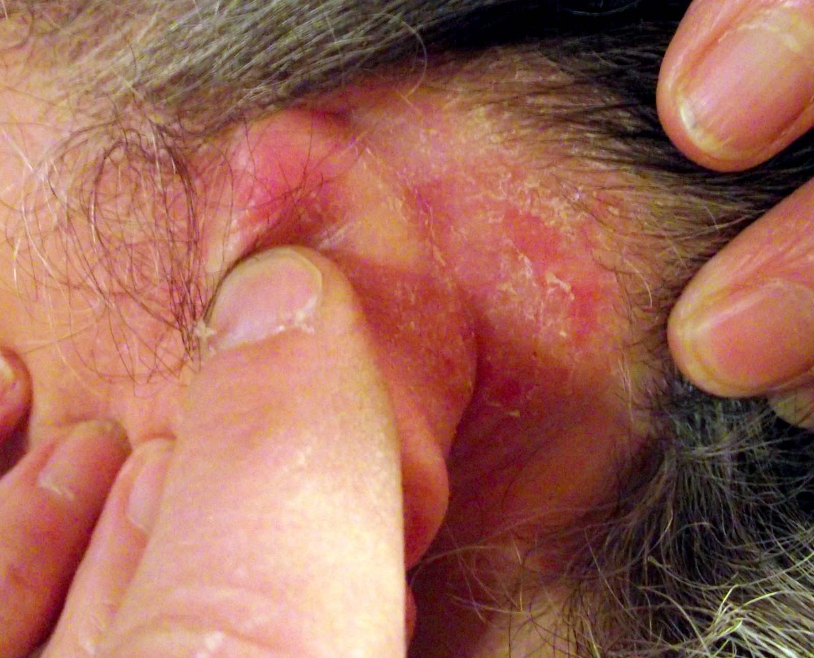 Itchy Ears- Seborrheic dermatitis is a common cause