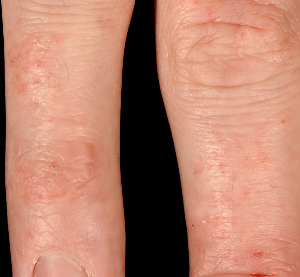 Pompholyx eczema: A common cause of Itchy Hands and Feet