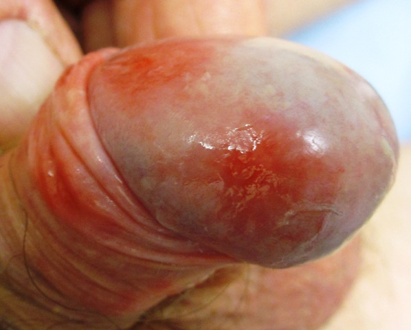 Itchy rash on the penis- Balanitis
