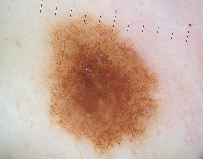 Melanoma diagnosis- This is a benign mole