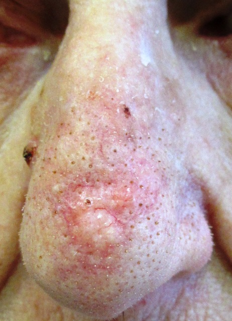 Basal cell carcinoma on the nose-cancer