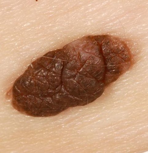 Example of a Raised mole