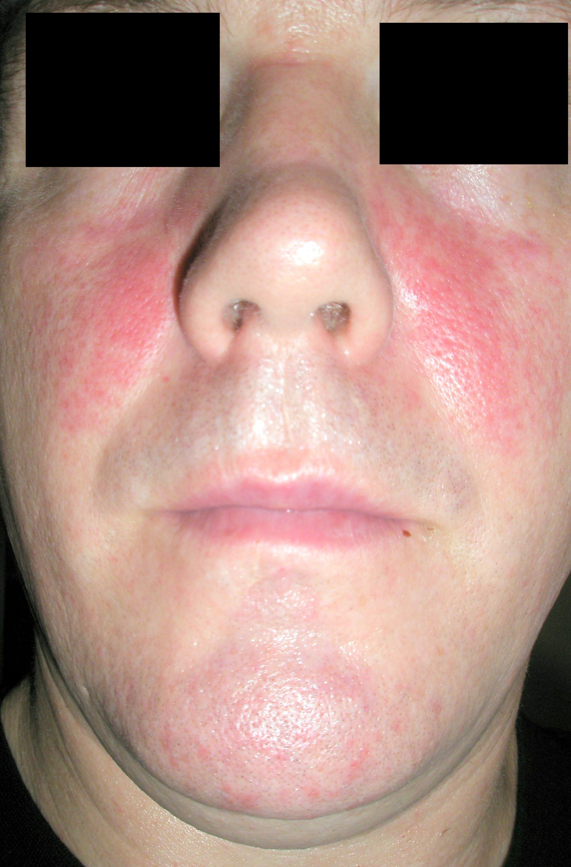 Red cheeks are often caused by rosacea