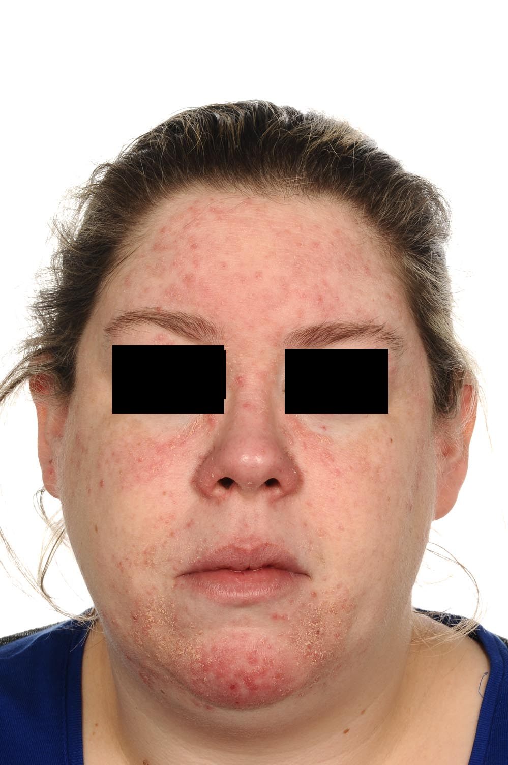 Red spots on the face -rosacea