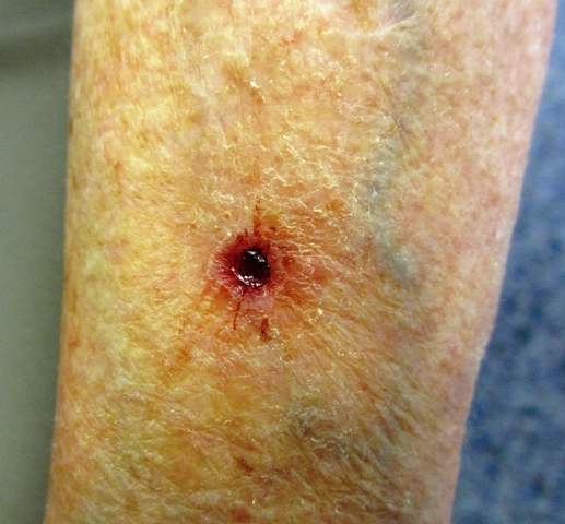 Skin ulcers can be a skin of skin cancer