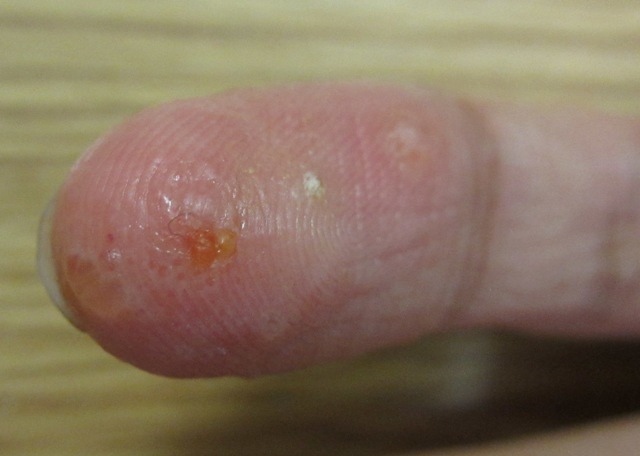Itchy Rash with blisters:  may need treatment with antibiotics
