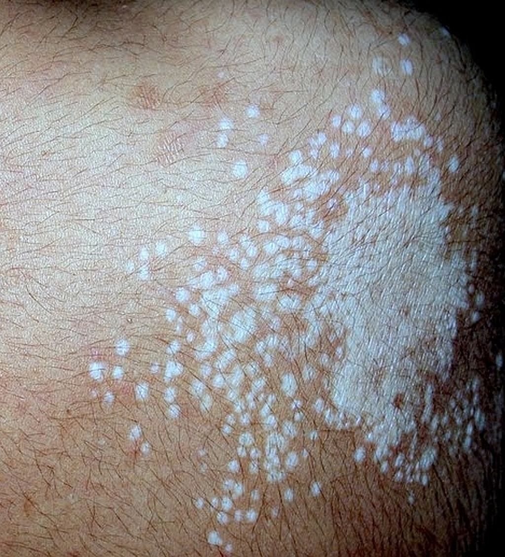 White spots on skin