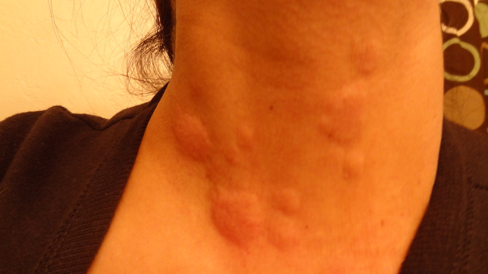 Skin hives can also be caused by a contact dermatitis
